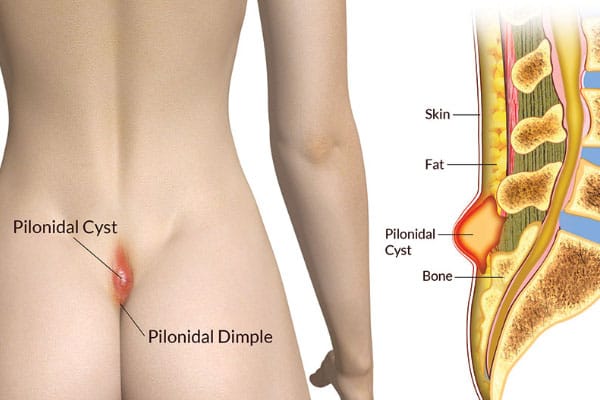 Pilonidal cyst cross-section diagram